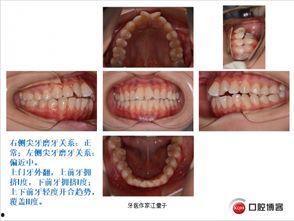 成人硬腭拔牙视频