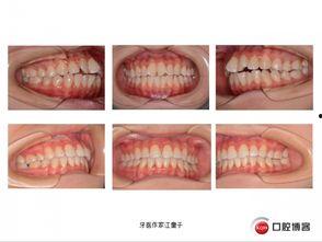 成人硬腭拔牙视频