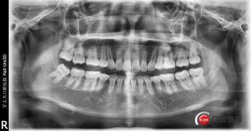 成人硬腭拔牙视频